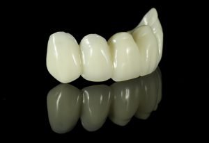 Smiles First Dental | Dental Crowns and Bridges | Dentist Northmead