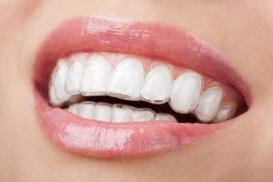 Smiles First Dental | Invisalign | Dentist Northmead