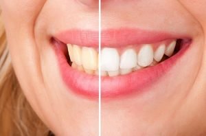 Smiles First Dental | Teeth Whitening | Dentist Northmead
