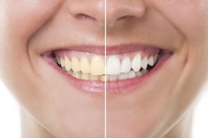 Top 4 Home Remedies for Yellow Teeth