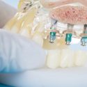 Dental Implants in Northmead: Should You Shop Around?