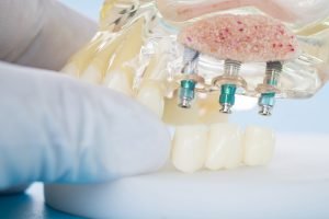 Dental Implants in Northmead Should You Shop Around