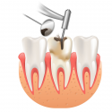 Root Canal Treatment: What do I need to know?